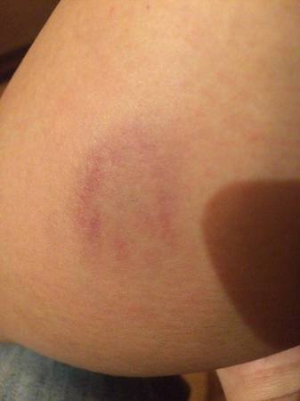 Az első kezelés után 